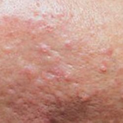 What is true of sebaceous hyperplasia milady